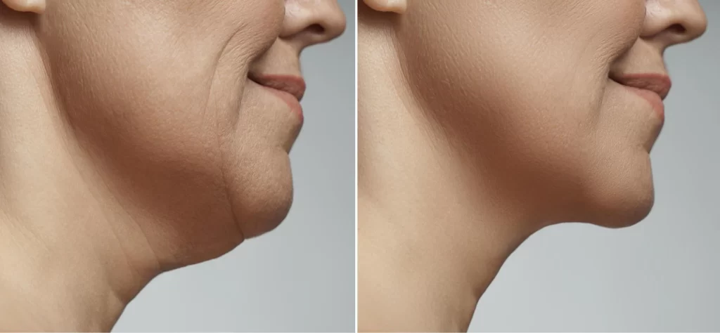 picture of before and after jaw slimming treatment